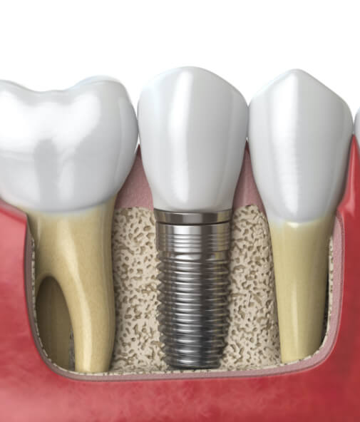 Animated smile comparing dental implant supported tooth to natural teeth