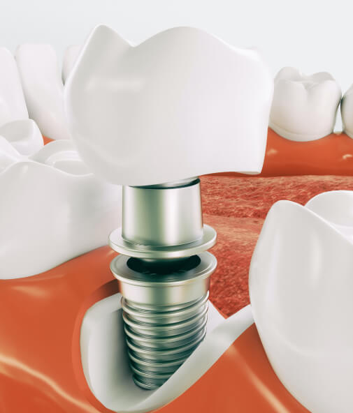Animated smile demonstrating the four step dental implant process