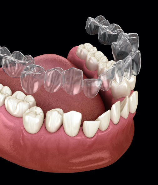 Animated smile during Invisalign tray placement