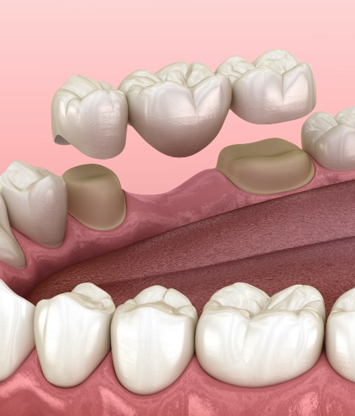 Animated smile during dental bridge placement