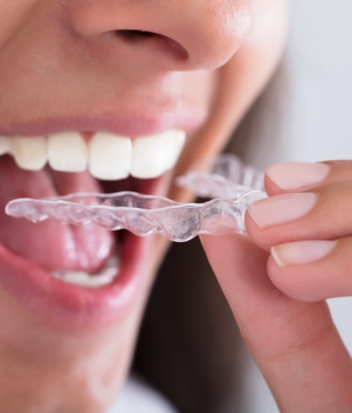 Pating placing an Invisalign clear aligner