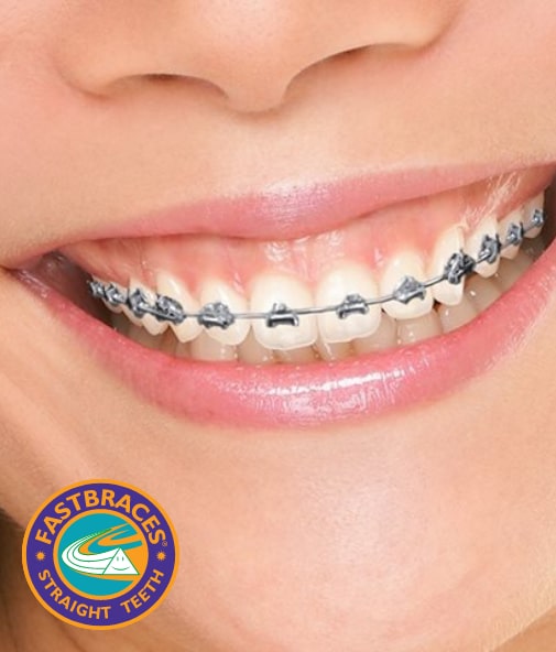 Closeup of smile with FastBraces orthodontics in place
