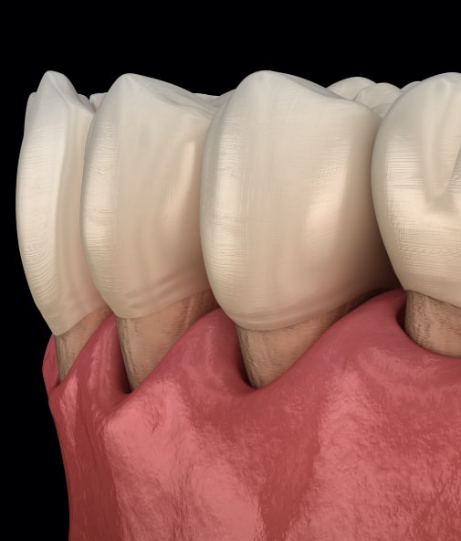 Animated smile with receiving soft tissue caused by gum disease