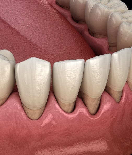 Animated smile in need of periodontal treatment