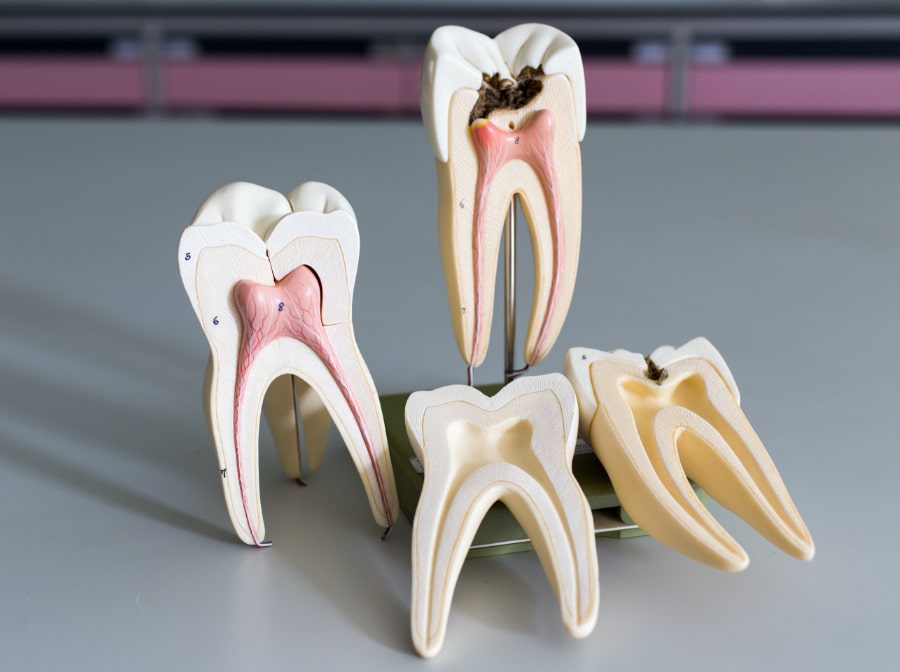 Model of healthy tooth compared to tooth in need of root canal therapy