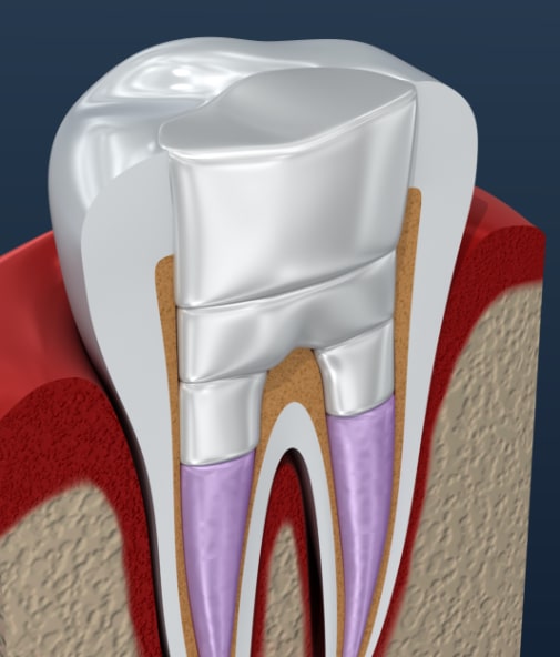 Animated tooth after root canal therapy and dental crown placement