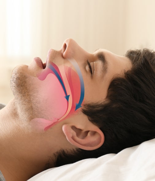 Man snoring with animated airway obstruction over his profile