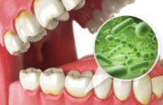 Animated smile with zoom in on bacteria to diagnose gum disease
