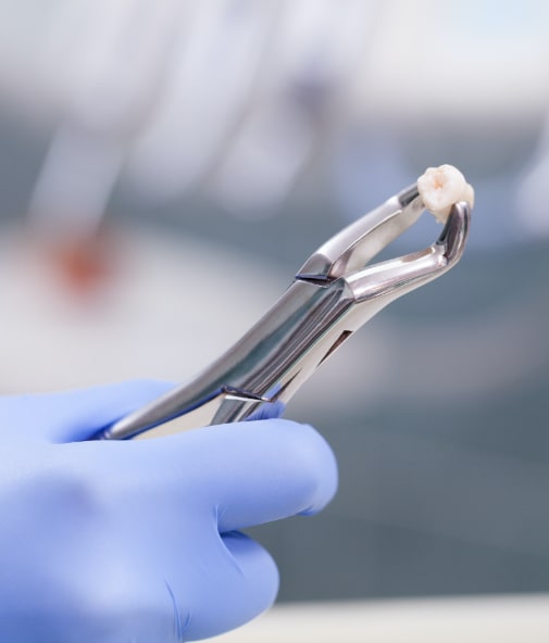 Metal clasp holding an extracted wisdom tooth