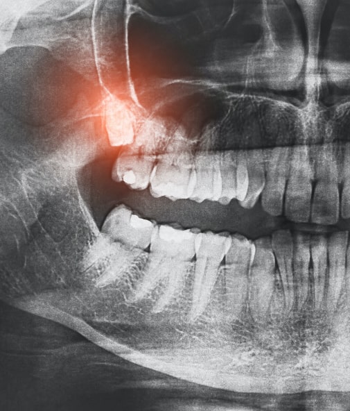 X-ray of impacted wisdom tooth before extraction procedure