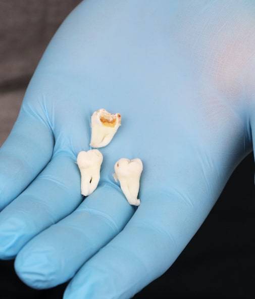 Three wisdom teeth after removal