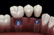 Animated smile with dental implant supported fixed bridge