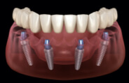 Animated smile with dental implant supported denture
