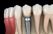 Animated smile with dental implant supported dental crown