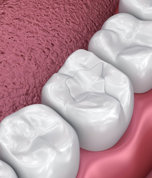 Animated smile with tooth colored filling after safe mercury filling removal