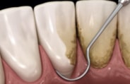 Animated smile during scaling and root planing