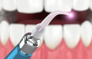 Er YAG laser dentistry hand tool