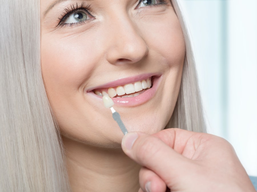 Woman's smile compared to porcelain veneer shade chart