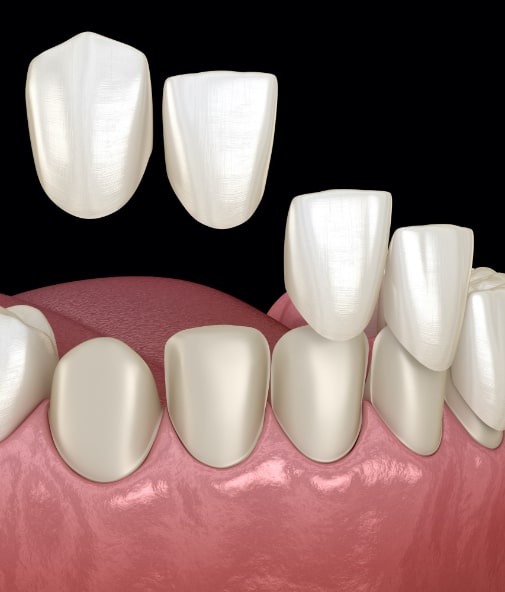 Woman considering porcelain veneers
