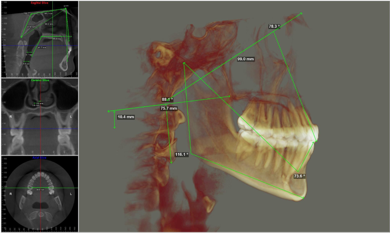 Man placing a sleep apnea oral appliance